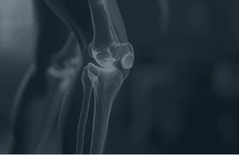 Knee Replacement Surgery